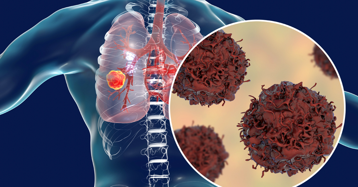 Những dấu hiệu cho thấy nguy cơ bị ung thư phổi